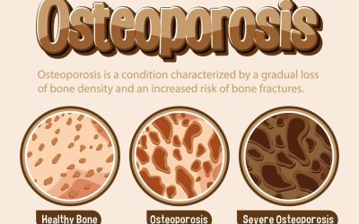 What is your Osteoporosis Risk? Take this short assessment