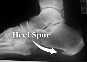 What is a Heel Spur? 7 Helpful Hints